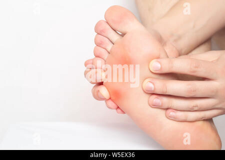 Rot und entzündeter Haut auf der Sohle des Patienten s Füße, Schmerz von Hühneraugen und Hühneraugen mit einem Schaft, Trockene und raue Haut, Nahaufnahme, Kopie Raum Stockfoto