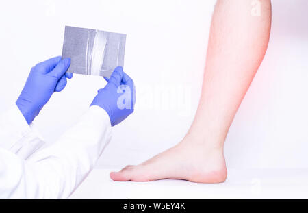 Arzt Traumatologist hält MRI Snapshot des Kalbes Bänder des männliches Bein, Verstauchung, medizinische Stockfoto