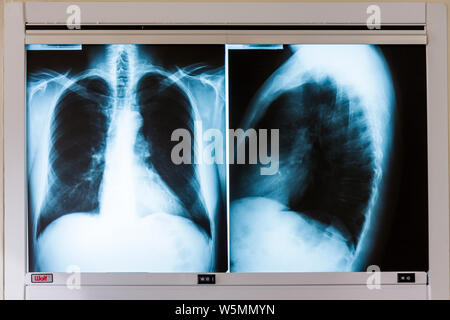 Miami Beach, Florida, Mt. Mount Sinai Medical Center, Krankenhaus, Gesundheitswesen, Arztpraxis, Röntgenaufnahme des männlichen Erwachsenen, Radiographie, Diagnose, Test, Untersuchung, Screenin Stockfoto