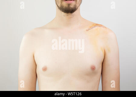 Gebrochene Schlüsselbein/Schlüsselbein/clavicula nach der Operation nach einem Fahrrad crash Stockfoto