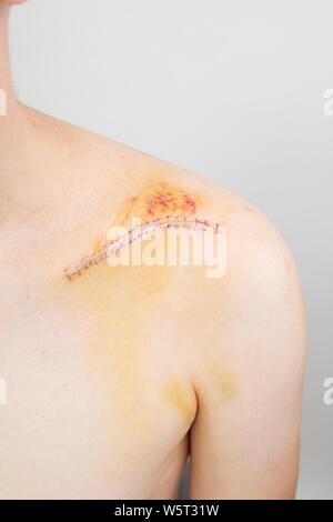 Gebrochene Schlüsselbein/Schlüsselbein/clavicula nach der Operation nach einem Fahrrad crash Stockfoto