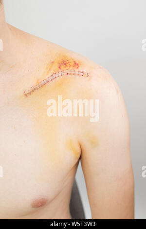 Gebrochene Schlüsselbein/Schlüsselbein/clavicula nach der Operation nach einem Fahrrad crash Stockfoto