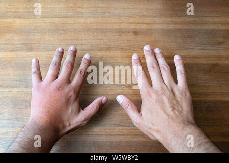 Der Vergleich von zwei männlichen Händen von Biene oder Wespe gestochen. Hand, Schwellungen, Entzündungen, Hautrötungen sind Anzeichen einer Infektion. Insekt Biss auf der Linken auf hölzernen Tab Stockfoto