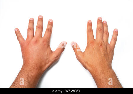 Der Vergleich von zwei männlichen Händen von Biene oder Wespe gestochen. Hand, Schwellungen, Entzündungen, Hautrötungen sind Anzeichen einer Infektion. Insekt Biss auf der linken Hand auf Weiß zurück Stockfoto