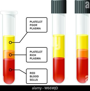 Blut nach der Trennung von Thrombozyten in der Zentrifuge im Reagenzglas, PRP Infografiken, platelet-rich Plasma Stock Vektor