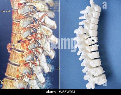 Ein Arzt zeigt eine 3D-gedruckten Modell für Thorax orthopädische Chirurgie auf den ersten Krankenhaus von Qinhuangdao in Qinhuangdao Stadt eingesetzt, der ostchinesischen Provinz Hebei provin Stockfoto