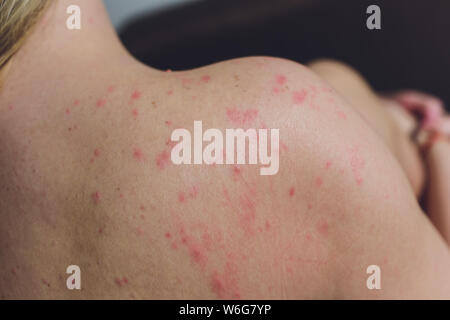 Close up Allergie Hautausschlag, um die Rückseite des menschlichen mit Dermatitis Problem der Ausschlag, Allergie Hautausschlag und gesundheitliches Problem. Stockfoto