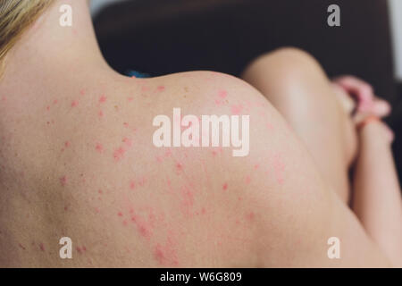 Close up Allergie Hautausschlag, um die Rückseite des menschlichen mit Dermatitis Problem der Ausschlag, Allergie Hautausschlag und gesundheitliches Problem. Stockfoto