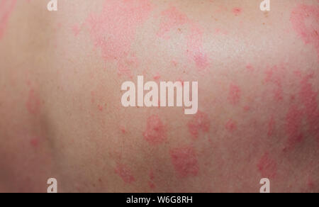 Close up Allergie Hautausschlag, um die Rückseite des menschlichen mit Dermatitis Problem der Ausschlag, Allergie Hautausschlag und gesundheitliches Problem. Stockfoto