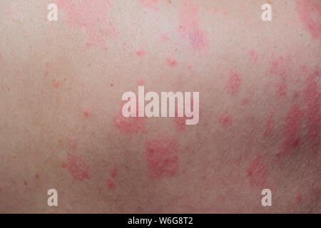 Close up Allergie Hautausschlag, um die Rückseite des menschlichen mit Dermatitis Problem der Ausschlag, Allergie Hautausschlag und gesundheitliches Problem. Stockfoto