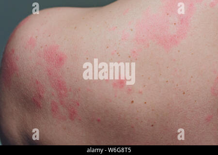 Close up Allergie Hautausschlag, um die Rückseite des menschlichen mit Dermatitis Problem der Ausschlag, Allergie Hautausschlag und gesundheitliches Problem. Stockfoto