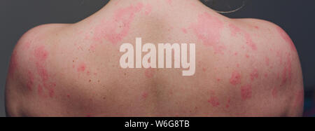 Close up Allergie Hautausschlag, um die Rückseite des menschlichen mit Dermatitis Problem der Ausschlag, Allergie Hautausschlag und gesundheitliches Problem. Stockfoto