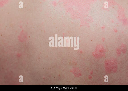 Close up Allergie Hautausschlag, um die Rückseite des menschlichen mit Dermatitis Problem der Ausschlag, Allergie Hautausschlag und gesundheitliches Problem. Stockfoto