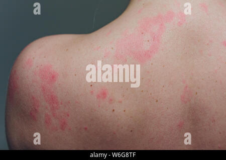 Close up Allergie Hautausschlag, um die Rückseite des menschlichen mit Dermatitis Problem der Ausschlag, Allergie Hautausschlag und gesundheitliches Problem. Stockfoto