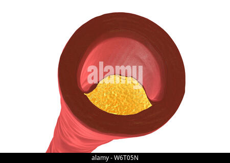 Atheromatous Plakette im Blutgefäß, Computer Bild. Ein Atherom Cholesterin verursacht eine Verengung einer Arterie (Arteriosklerose). Stockfoto