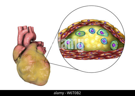 Herzkrankheit, computer Abbildung. Kranke Fettsäuren Herz und Querschnitt einer atherosklerotischen Plaque und die histologische Struktur, wie z.b. nekrotischen Zentrum, Schaum-Zellen und T-Lymphozyten. Die Wände sind von glatten Muskelzellen und Endothel der Blutgefäße. Stockfoto