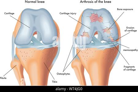 Medizinische Abbildung: die Symptome der Arthrose des Knies Stock Vektor