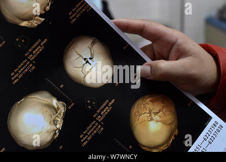 Eine Gehirn-CT-Scan zeigt die Risse auf zwei Jahre alter Junge Chinese Zhang Chun's Kopf, nachdem er von seinem Großvater mit einem Hammer angegriffen wurde, zu einem hospit Stockfoto