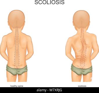 Vector Illustration von Skoliose bei Kindern Stock Vektor