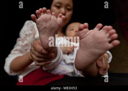 Die Füße der drei Monate alten Baby boy Hong Hong, die hat 15 Finger, 16 Zehen gezeigt werden durch seine polydactyl Mutter, die hat 12 Finger, 12 Zehen an Stockfoto