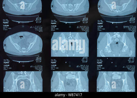 MRI sacroiliac Artikulation. Studie der ankylosierenden spondyloarthritis Patienten. Die Ergebnisse der Studie über die x-ray. Stockfoto