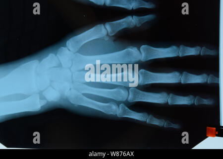 X-ray der Hände, ein Bild von den Knochen der Hände auf den x-ray. Stockfoto