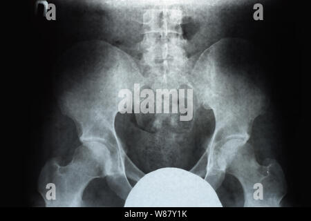 X-ray von Becken und Kreuzbein. X-ray Image. Stockfoto