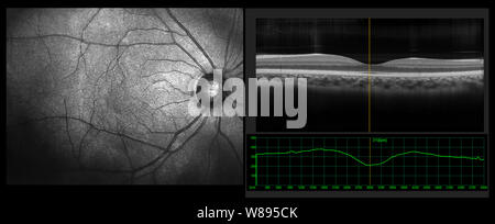 Ophthalmologische test-OCT optische Kohärenztomographie Messung. SLO Scan Blick auf die makula in der Netzhaut mit Schiffen Stockfoto