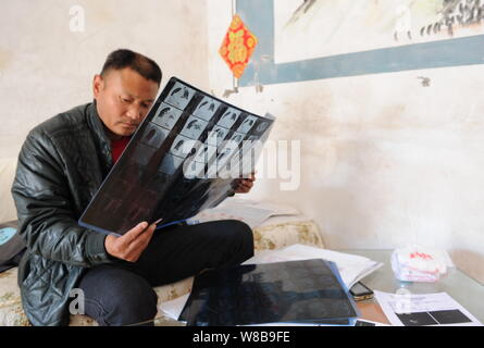 Chinesen Liu Yongwei, entdeckte seine rechte Niere gegangen war fehlt, nachdem er eine Brust Chirurgie in Xuzhou Medical School Krankenhaus zuletzt empfangenen Jun Stockfoto