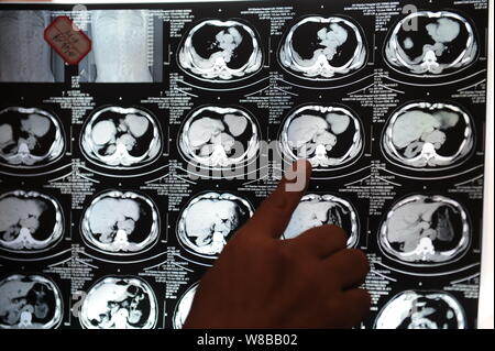 Chinesen Liu Yongwei, entdeckte seine rechte Niere gegangen war fehlt, nachdem er eine Brust Chirurgie in Xuzhou Medical School Krankenhaus zuletzt empfangenen Jun Stockfoto