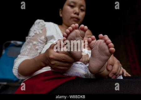 Die Füße der drei Monate alten Baby boy Hong Hong, die hat 15 Finger, 16 Zehen gezeigt werden durch seine polydactyl Mutter, die hat 12 Finger, 12 Zehen an Stockfoto