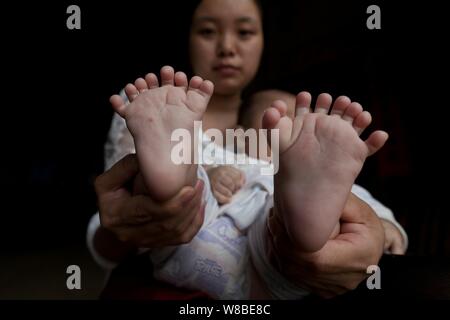 Die Füße der drei Monate alten Baby boy Hong Hong, die hat 15 Finger, 16 Zehen gezeigt werden durch seine polydactyl Mutter, die hat 12 Finger, 12 Zehen an Stockfoto