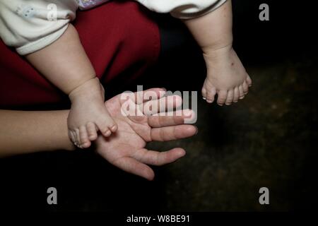 Die Füße der drei Monate alten Baby boy Hong Hong, die hat 15 Finger, 16 Zehen gezeigt werden durch seine polydactyl Mutter, die hat 12 Finger, 12 Zehen an Stockfoto