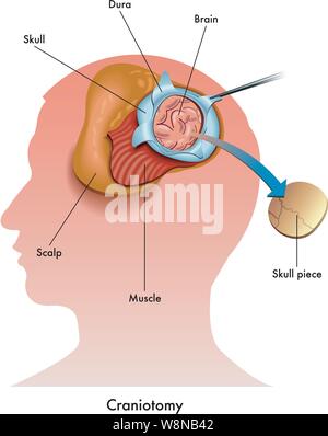 Einfache medizinische Abbildung: eine chirurgische Kraniotomie Stock Vektor