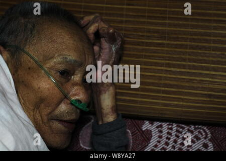 ----81-jährige Lin Yansong, der als alunite Bergmann seit 17 und leidet an Silikose gearbeitet hat, atmet Sauerstoff bei fanshan Krankenhaus im Fanshan Stockfoto