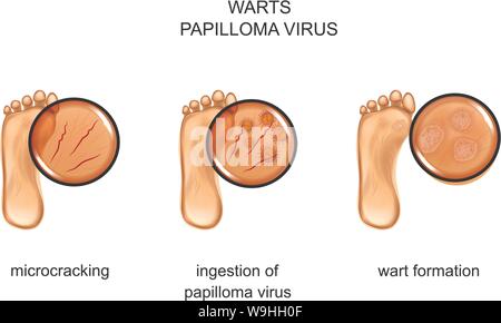Vector Illustration der Warzen auf der Sohle Stock Vektor
