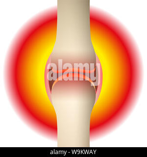 Gelenkschmerzen - schematische Darstellung der anatomischen Graphik eines synovial Joint mit Arthritis, Rheuma, Gicht, Arthrose oder Entzündung. Stockfoto