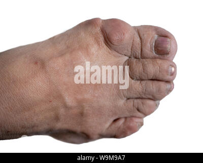 Menschlichen Fuß mit bunion Big Bone in der Nähe von hallux große Finger auf weißem Hintergrund. isolierte Ausschnitt bild Stockfoto