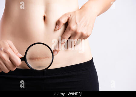 Nahaufnahme der Frau auf dem Bauch zeigen dunkle Narbe von einem Kaiserschnitt. Healthcare Konzept. Stockfoto