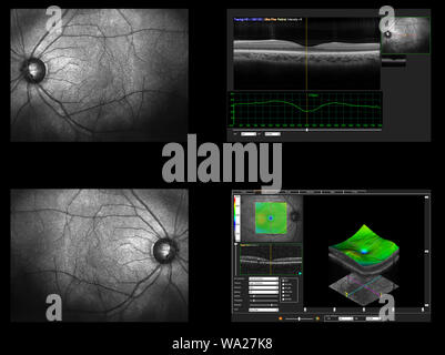 Ophthalmologische test-OCT optische Kohärenztomographie Messung. Scan der Makula in der Netzhaut, Schichten und Dicke der Netzhaut. Stockfoto