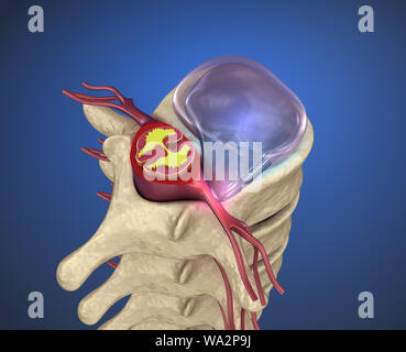 Hernaited Disc in der menschlichen Wirbelsäule in Details Stockfoto