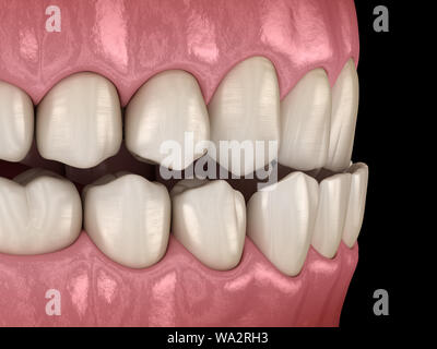 Unterbiss Bisses (Fehlstellung der Zähne). Medizinisch genaue Zahn 3D-Darstellung Stockfoto
