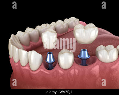 Prämolaren und Molaren Zahnkrone Installation über Implantat Abutments. Medizinisch genaue 3D-Abbildung der menschlichen Zähne und Zahnersatz Konzept Stockfoto