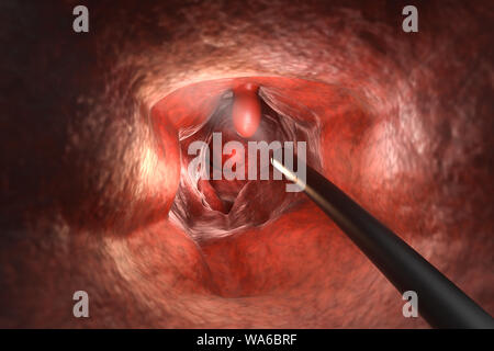 Colonoscopy Technologiekonzept mit 3D-rendering Endoskop innerhalb des Darmes mit polyp Stockfoto