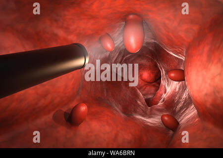 Colonoscopy Technologiekonzept mit 3D-rendering Endoskop innerhalb des Darmes mit polyp Stockfoto