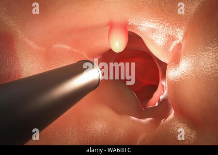 Colonoscopy Technologiekonzept mit 3D-rendering Endoskop innerhalb des Darmes mit polyp Stockfoto