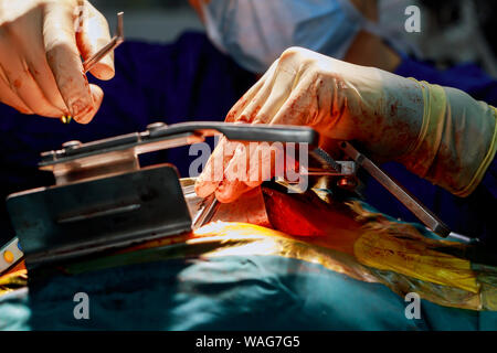 Herzchirurgie. Operation am offenen Herzen naht mehr Saphenous Vein koronarer Bypass-Operation Stockfoto