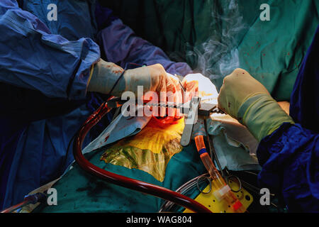 Der lunge Chirurg und team Thoraxchirurgie in Lungenkrebs durchführen Stockfoto