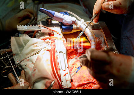 Ein Chirurg führt einer aortokoronaren Bypass Operation am offenen Herzen Arterie Stockfoto