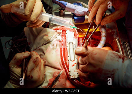 Herzchirurgie. Operation am offenen Herzen naht mehr Saphenous Vein koronarer Bypass-Operation Stockfoto